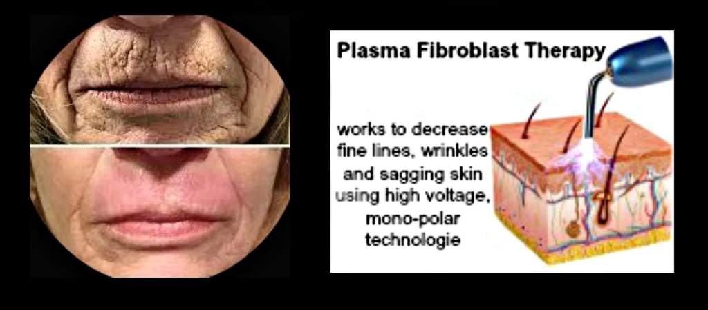 Deluxe Plasma Fibroblast Treatments What Are They And How Do They Work Jessicat S Medispa